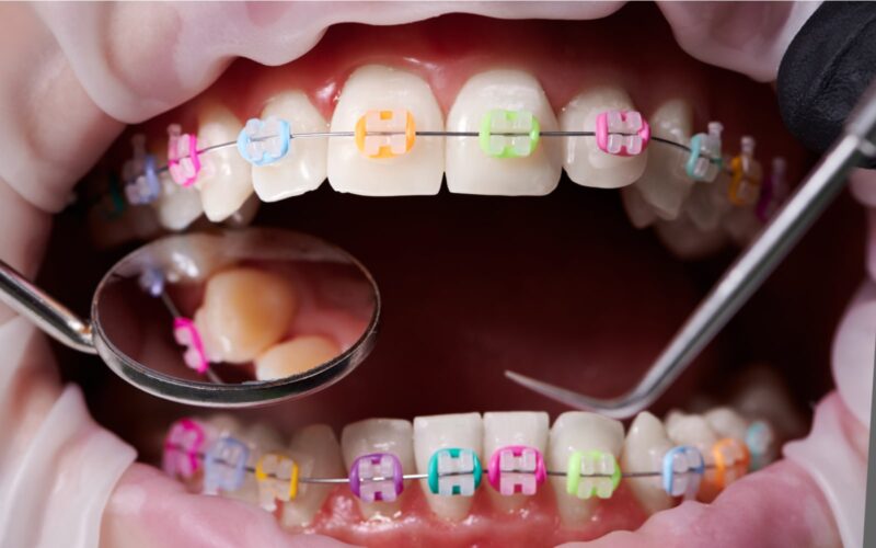 Multi-colored braces