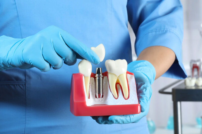 Root Canal showing the concept of Blog